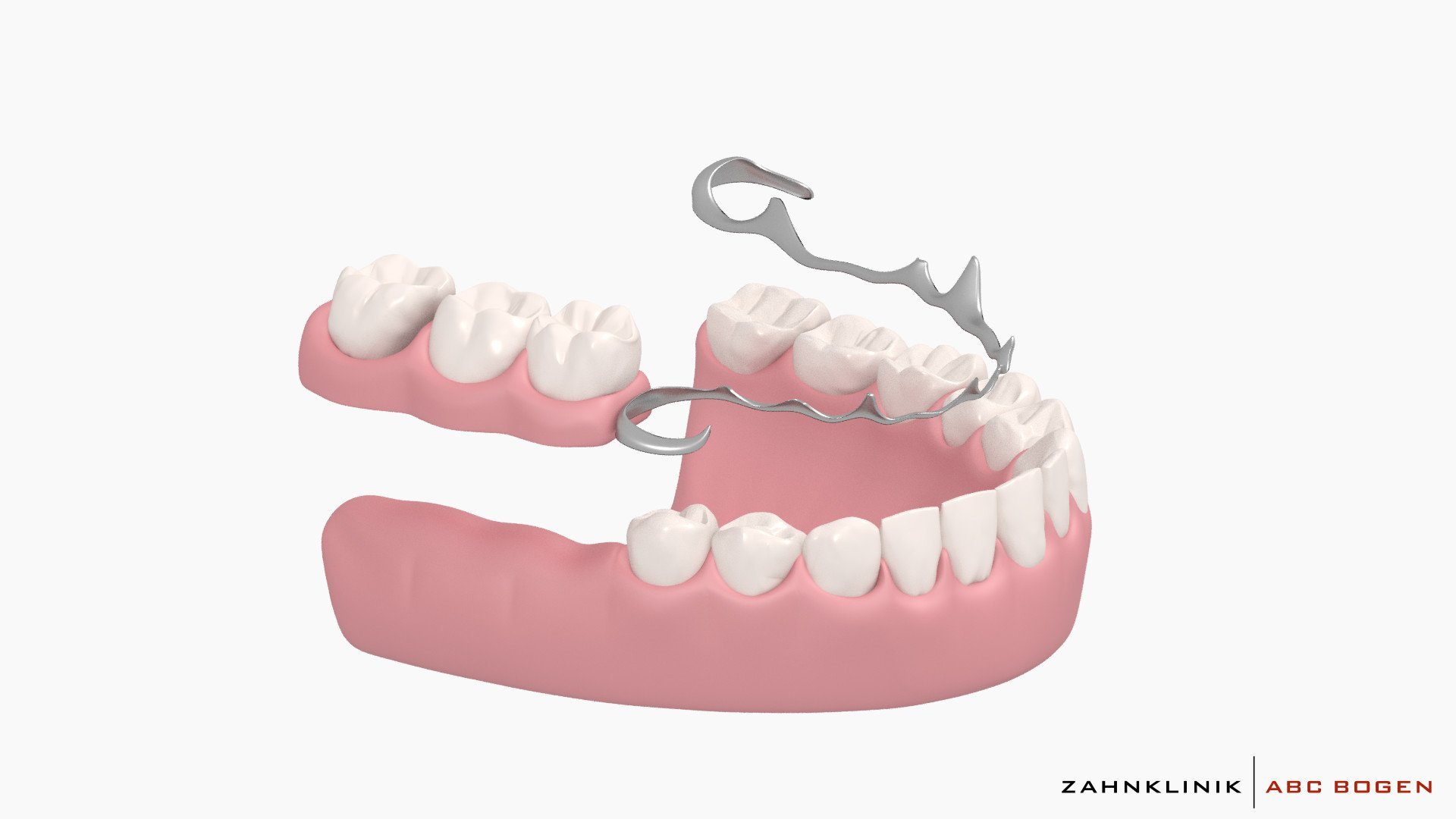 Протезирование зубов инвалидам 3 группы. Бюгельный протез (1 челюсть)+кламмер. Бюгельный протез кламмерный (remanium-700). Бюгельный протез замковый (2 замка Bredent). Бюгельный мостовидный протез.