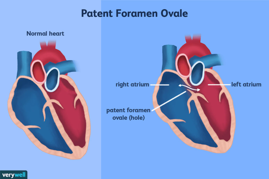 Foramen ovale сердце