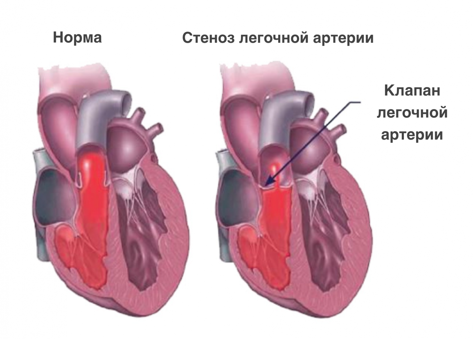 Стеноз клапана легочной артерии. Стеноз артериального клапана. Пролапс трикуспидального клапана 1-2 степени. Пролапс трехстворчатого клапана. Легочная артерия створки