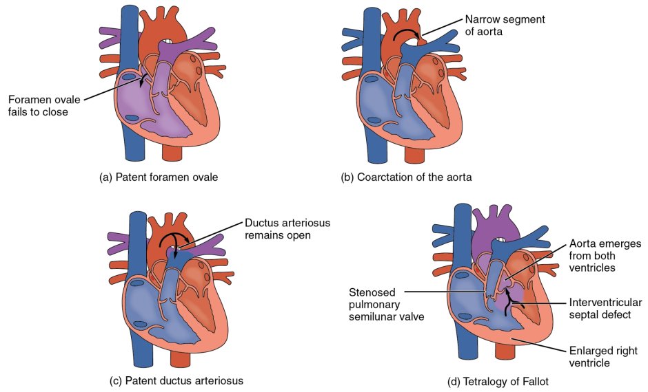 Искусственный митральный клапан сердца