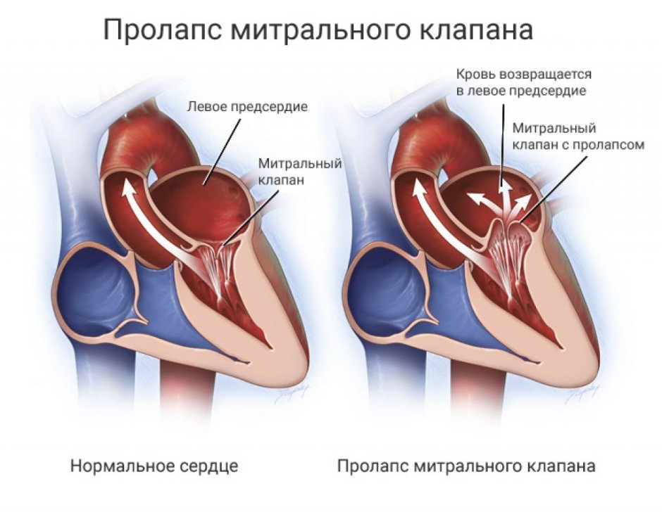 Врожденный порок сердца (ВПС)