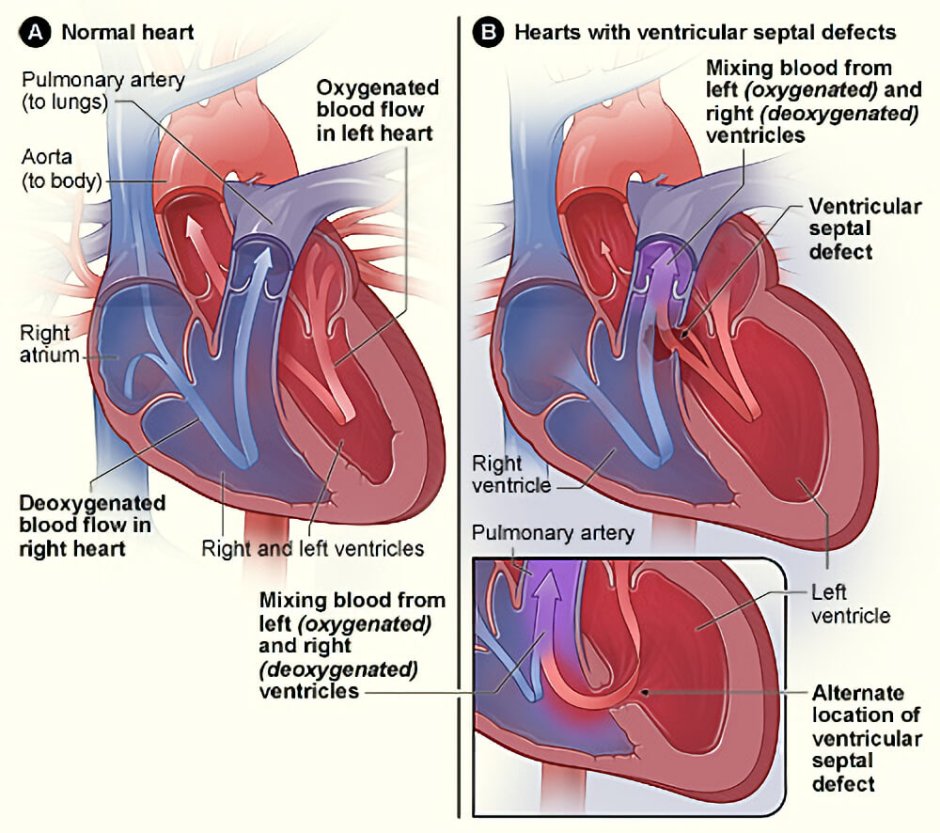 Пороки сердца (клапанной системы)