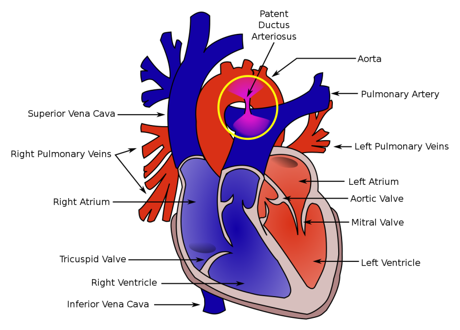 Легочная артериальная гипертензия сердце