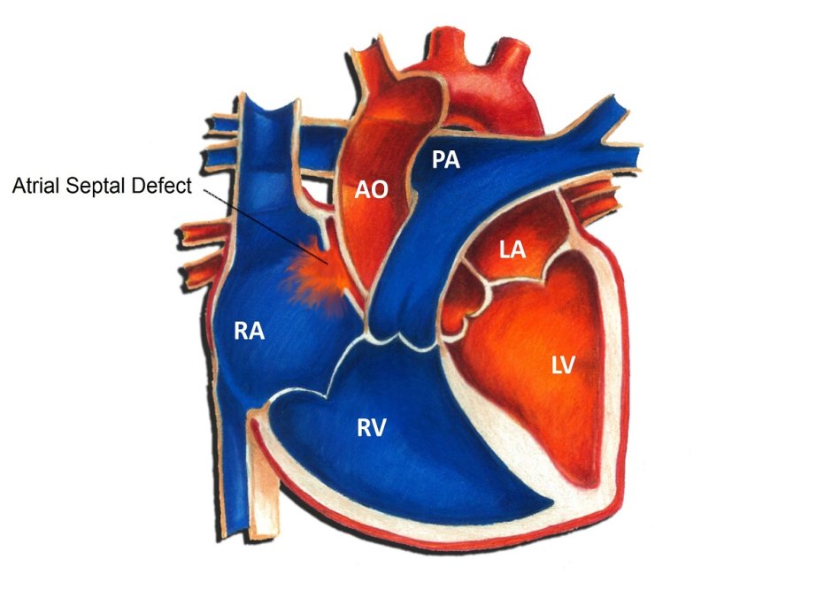 Митральный клапан сердца порок сердца