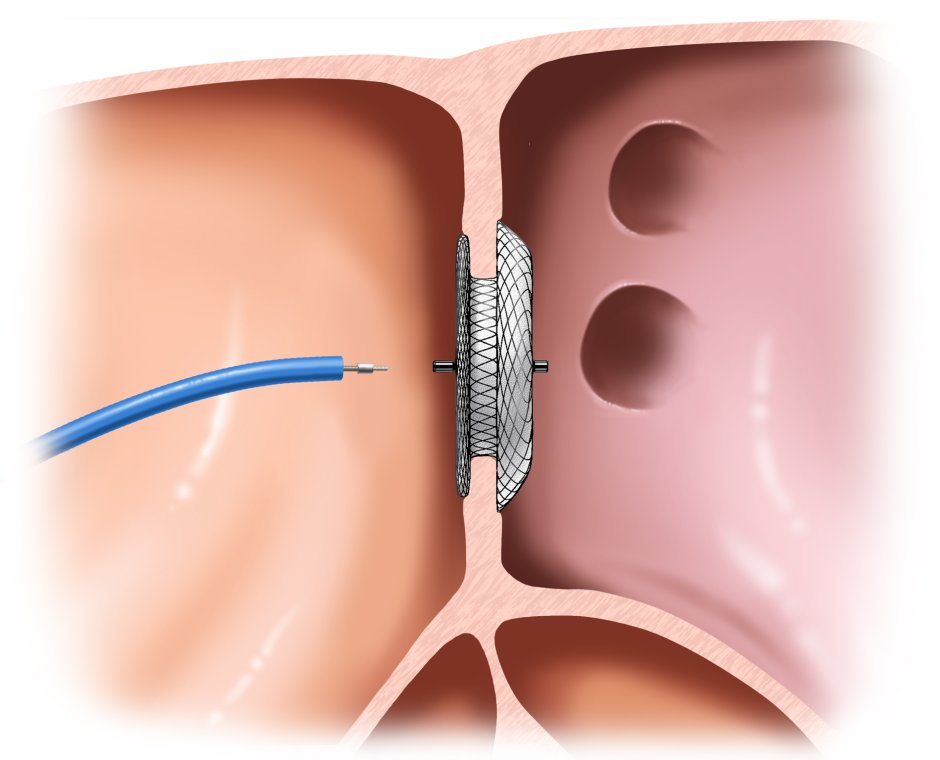 Открытый артериальный (боталлов) проток (ОАП
