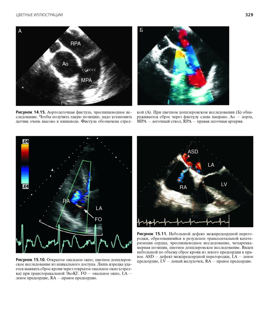 Ультразвуковая допплерография брахиоцефальных артерий норма